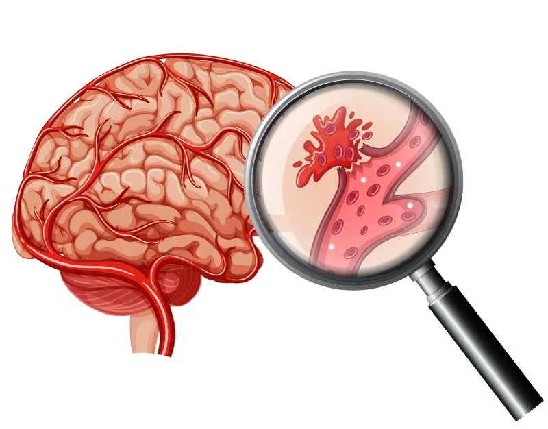 Hemorrhagic stroke illustration showing bleeding in the brain