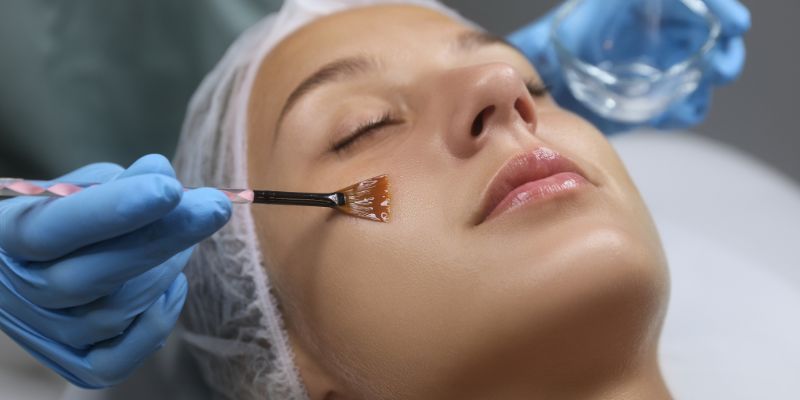 A chemical peel is a cosmetic procedure that involves applying a specially formulated chemical solution to the skin.